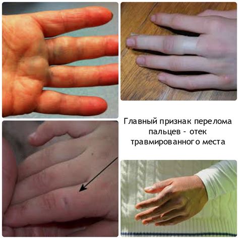 Переохлаждение пальцев рук - причины и облегчение боли в суставах